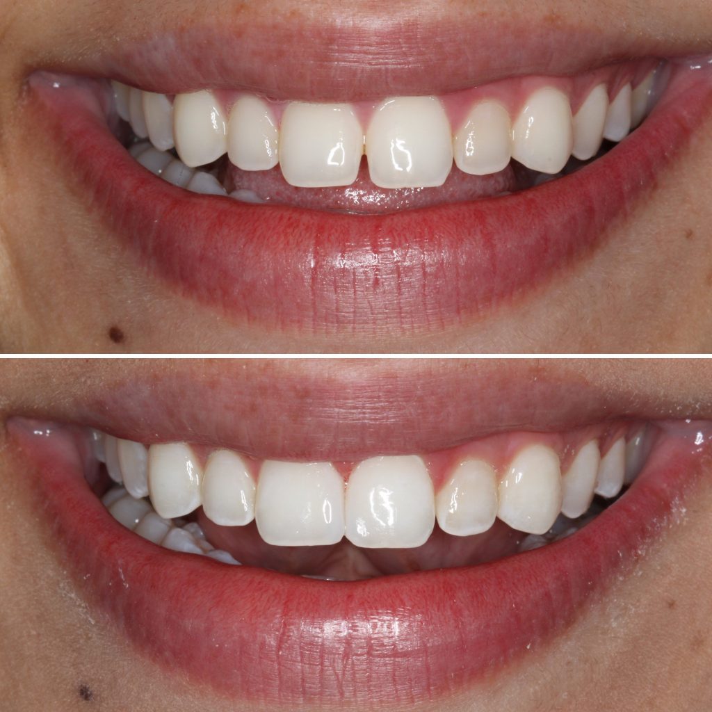 Cosmetic dentistry