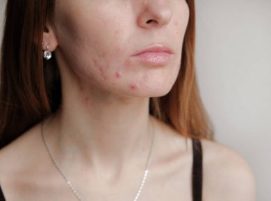How to Treat Adult Acne