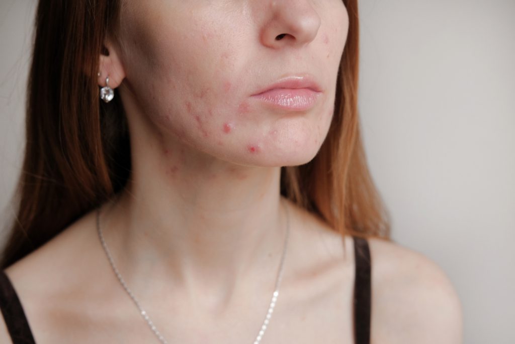 Treat Adult Acne