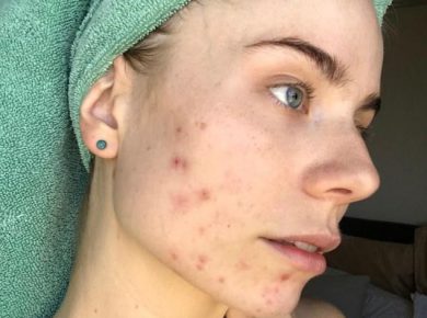 Medication Remedies to Treat Cystic Acne