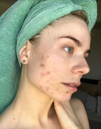 5-recommended-medication-remedies-to-treat-cystic-acne