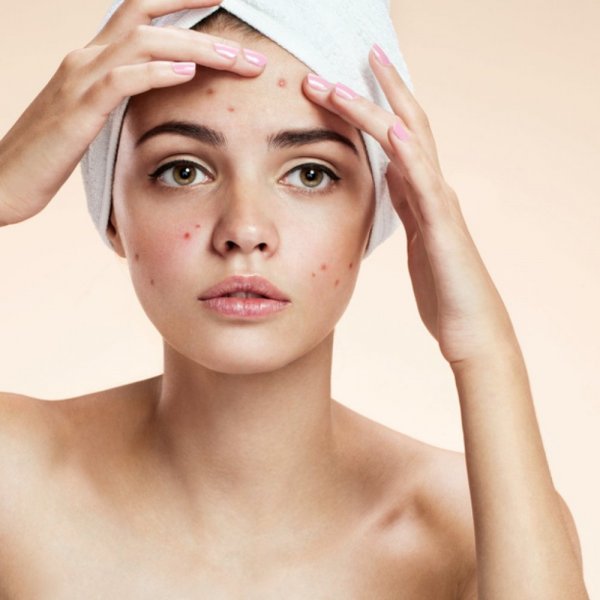 Maintaining Acne Free Skin