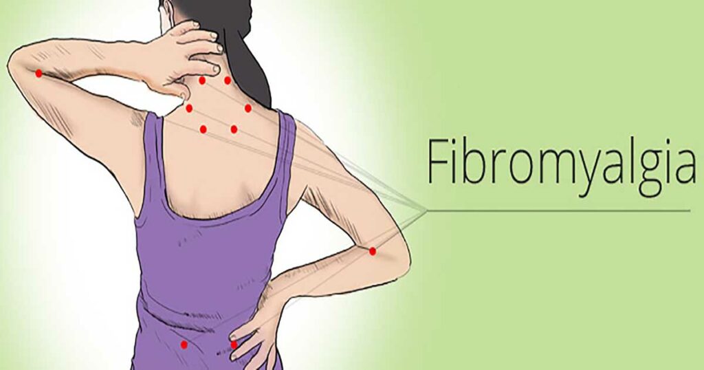 fibromyalgia