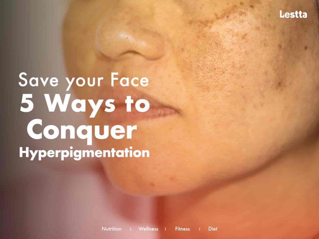 Conquer hyperpigmentation