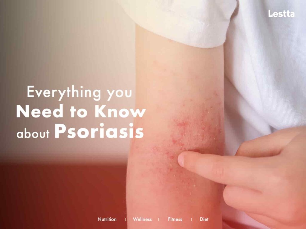 Everything you need to know about Psoriasis